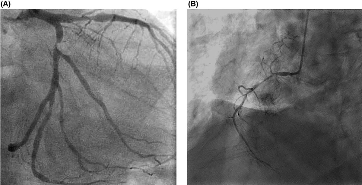 Artificial Organs (@artiforgans) on Twitter photo Programmatic approach to patients with advanced #IschemicCardiomyopathy: Integrating #Microaxial support into strategies for the #ModernEra
👉tinyurl.com/nhmh96fa
<a href="/CleClinicHVTI/">Cleveland Clinic Heart, Vascular & Thoracic</a> <a href="/EdSolteszMD/">Edward Soltesz MD MPH</a> #HeartFailure #HighRiskCABG Programmatic approach to patients with advanced #IschemicCardiomyopathy: Integrating #Microaxial support into strategies for the #ModernEra
👉tinyurl.com/nhmh96fa
<a href="/CleClinicHVTI/">Cleveland Clinic Heart, Vascular & Thoracic</a> <a href="/EdSolteszMD/">Edward Soltesz MD MPH</a> #HeartFailure #HighRiskCABG