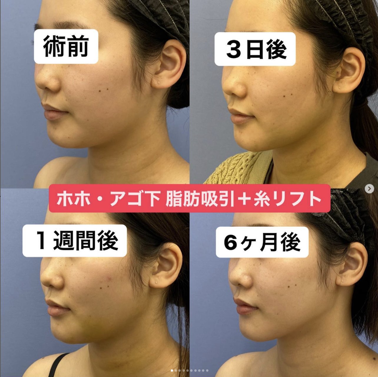 脂肪吸引のスペシャリスト/くずしま先生 on X: 