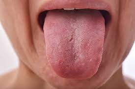 on_diseases's tweet photo. A decrease in #red blood cells when the #body can't #absorb enough #vitaminB12 causes #Pernicious anemia.
Read more: https://t.co/HWmruSvBKg
Visit and publish: https://t.co/vBXX8rMnA3 https://t.co/Z5p3uFsVGx