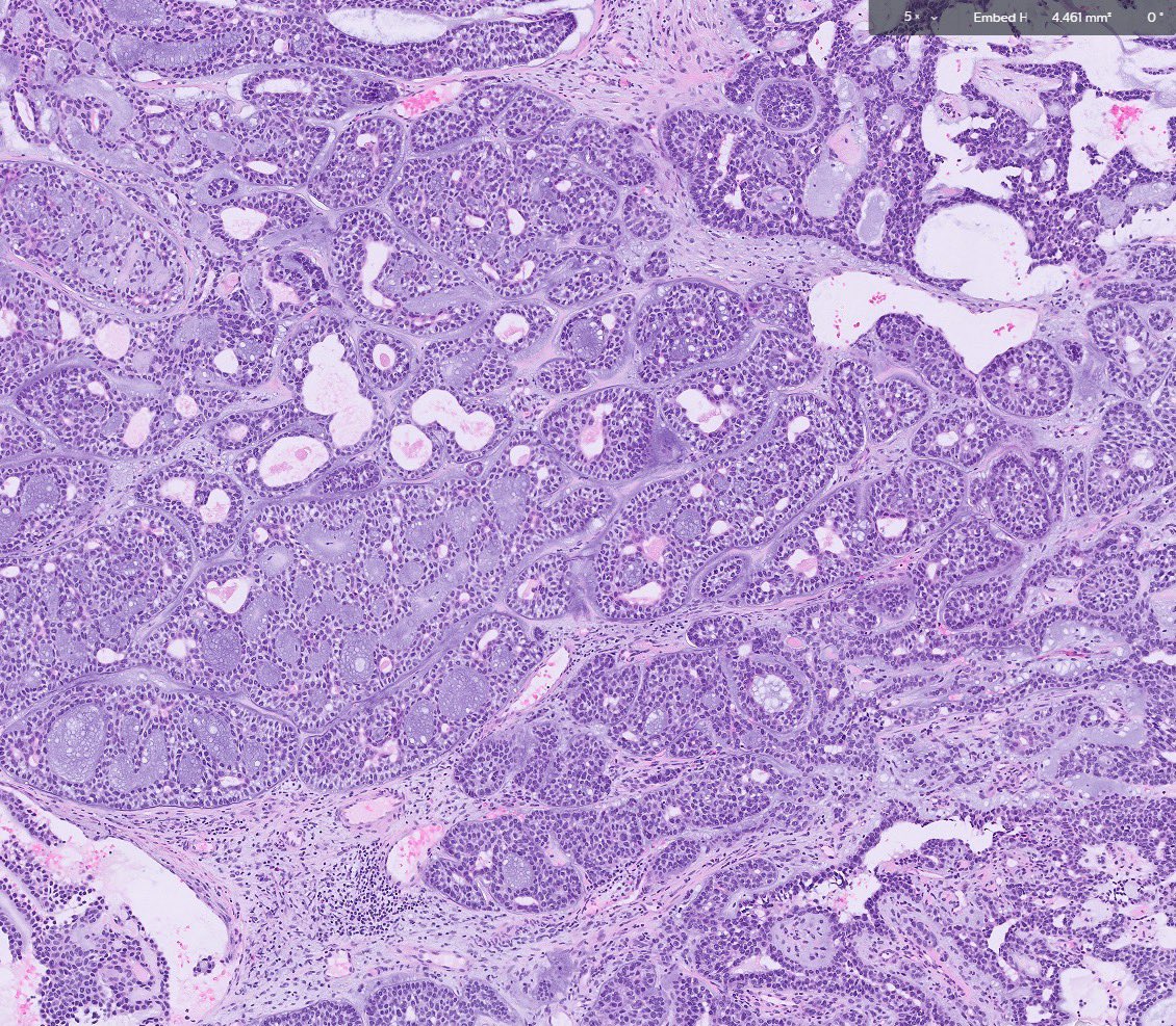 Nasal mass #pathology #pathtwitter #surgpath