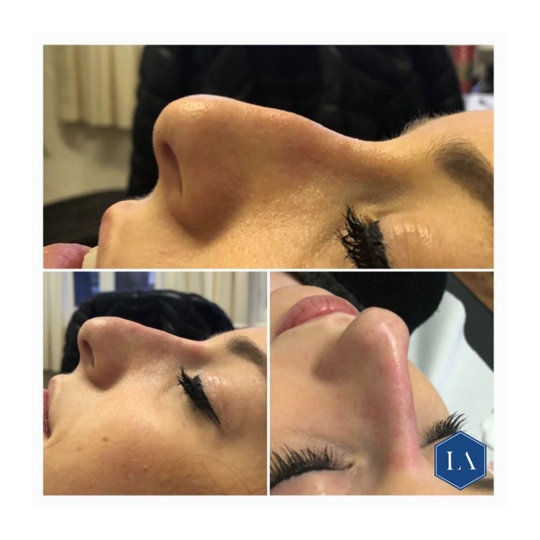 Nasal reshaping, using the very best dermal filler available. Fantastic results for my client.

#allergan #voluma #nasalbridge #thebest #medicalspecialists #dermalfillers #professional #bestproductsonthemarket #essex #kent #london