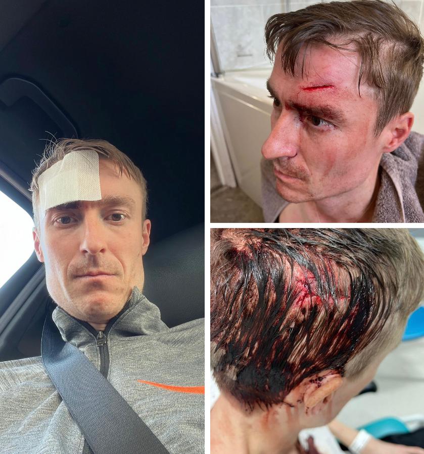 DarbyRimmerMND's tweet image. Part 1/2 - A reality of MND.

As your body, arms and legs become weaker you are more susceptible to trips and falls. Which in turn, you can’t use your arms to break your fall.

2 falls have resulted in trips to A&amp;amp;E. 

#attackMND #MND #darbyrimmermndfoundation #motorneuronedisease