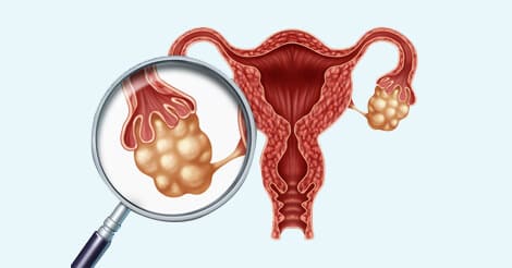 JObstetrics's tweet image. Ovarian cancer occurs when abnormal cells in ovaries or Fallopian tubes grow and multiply out of control. Ovaries are part of the female reproductive system.
Visit us for more information: lnkd.in/ekc75WtY
#Ovarian #cancer #abnormal #cells #ovaries #fallopiantubes #grow