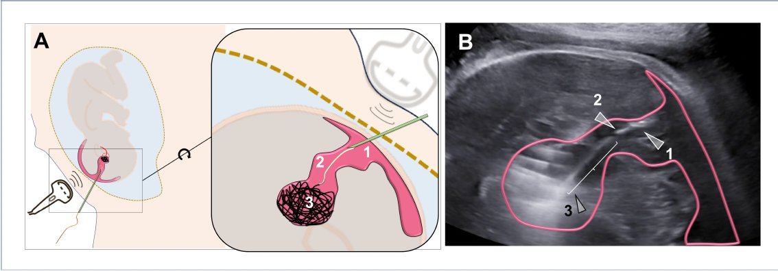 AJOG Images in Obstetrics: Prenatal treatment of a vein of Galen malformation by embolization and one-year follow-up: Illustration of the technique with a patient with a vein of Galen malformation (VOGM). ow.ly/sl5050Qekha