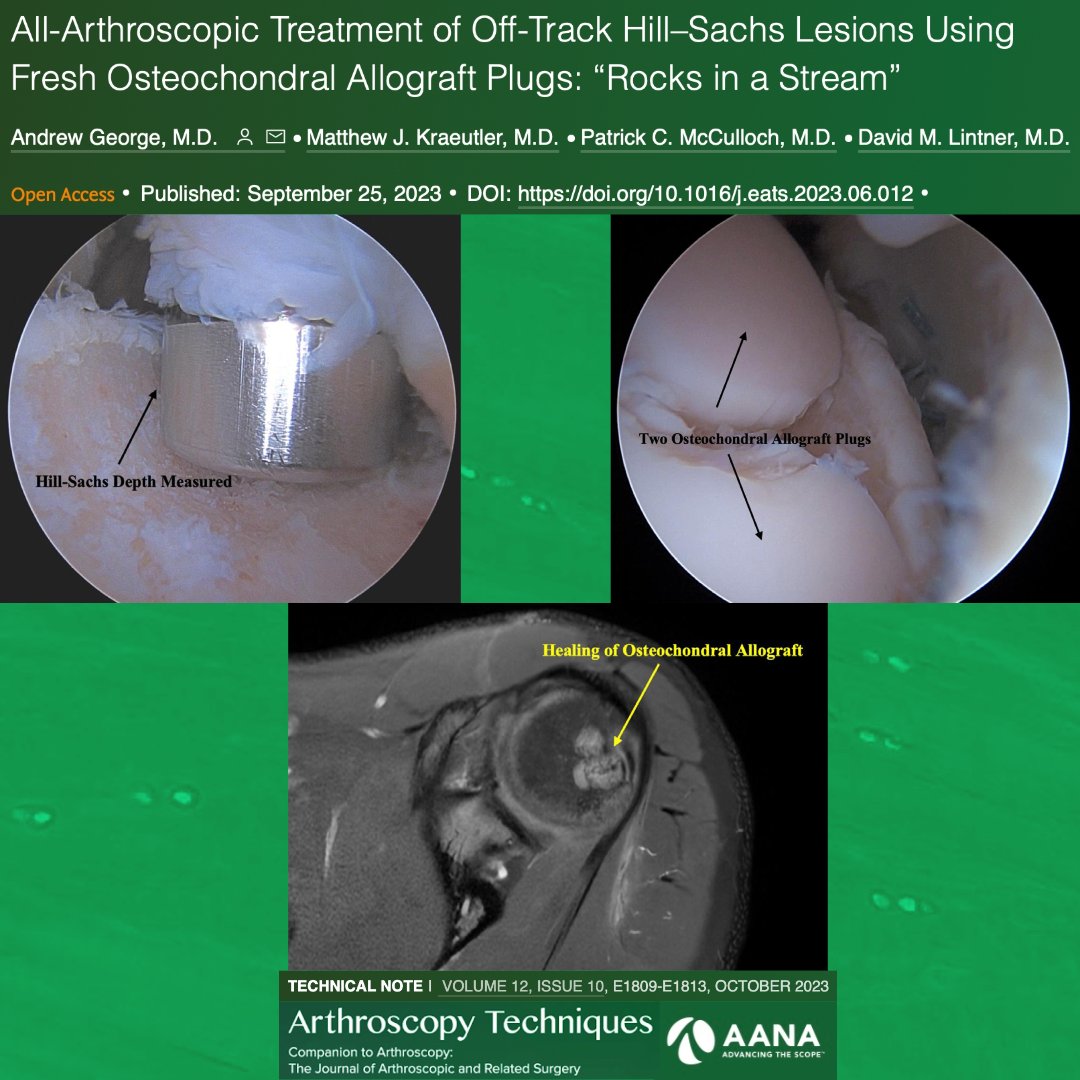 Tired of dealing with size-matching and graft harvesting for an engaging Hill Sachs lesion? Check out this new technique! ow.ly/CArN50Q4EiR #Hill-Sachs #Shoulder #OCA @MethodistHosp