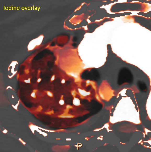 Rounded atelectasis can occur anywhere!
Indeterminate RUL lung nodule, with pleural thickening (red arrows). Oblique parasagittal recon nicely shows "comet-tail" sign.
On #SpectralCT, characteristic intense iodine uptake.
Stable on follow up for several years. #radres #FOAMed