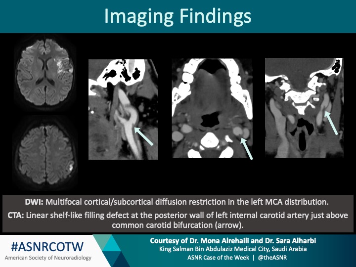 TheASNR's tweet photo. Great job everyone! 

This is a case of a carotid web with acute ischemia.  See you next week!  

#Neuro #Neurorad #Erad #radres #FOAMed #FOAMrad #medtwitter #ASNRCOTW https://t.co/kQMfazIHsz