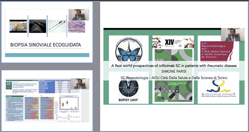 Sim_Orizon's tweet photo. 🌐 Bridging #Gastroenterology &amp; #Rheumatology at #IGIBD. Beyond the gut, up to 25% of IBD patients battle rheumatic symptoms. 🧐 Can #synovialbiopsy help us decide the best strategy for these patients? 🤝 #IBD #HealthInnovation @IGIBD @SteAlivernini @vincevenerito https://t.co/pGmcydkMZy