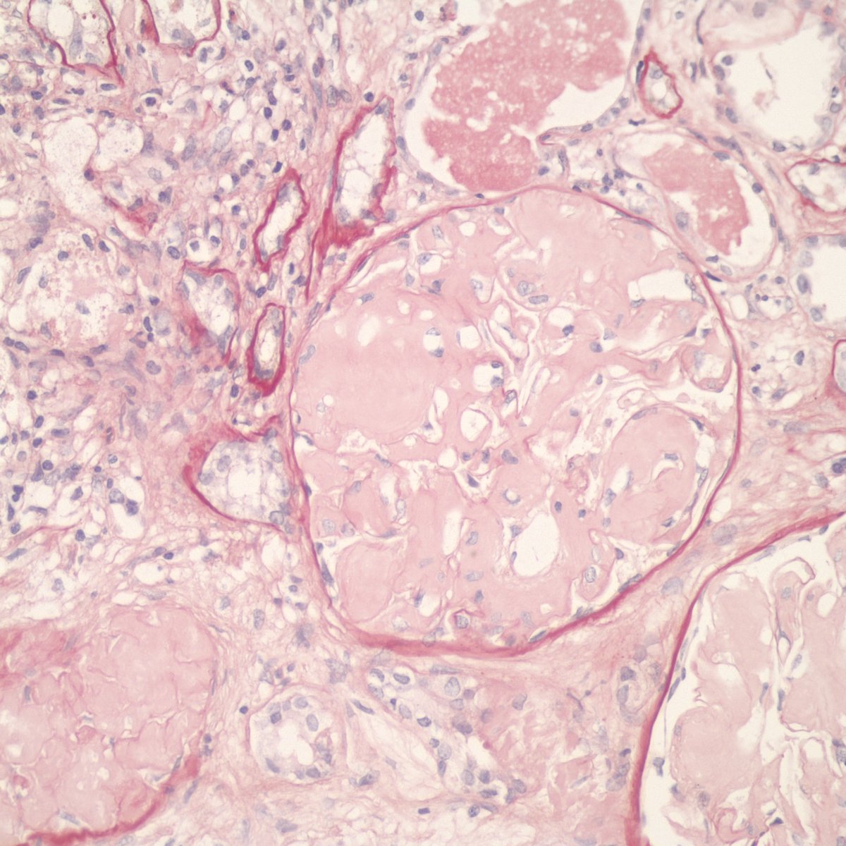 Amyloidosis in the kidney is interesting, not only does it affect the vessels, but it also involves the glomerulus. The amorphic appearance gives the diagnosis away. #surgpath #pathX #pathtwitter #pathology #pathologists #amyloidosis #kidney #nephropathology #nephrology