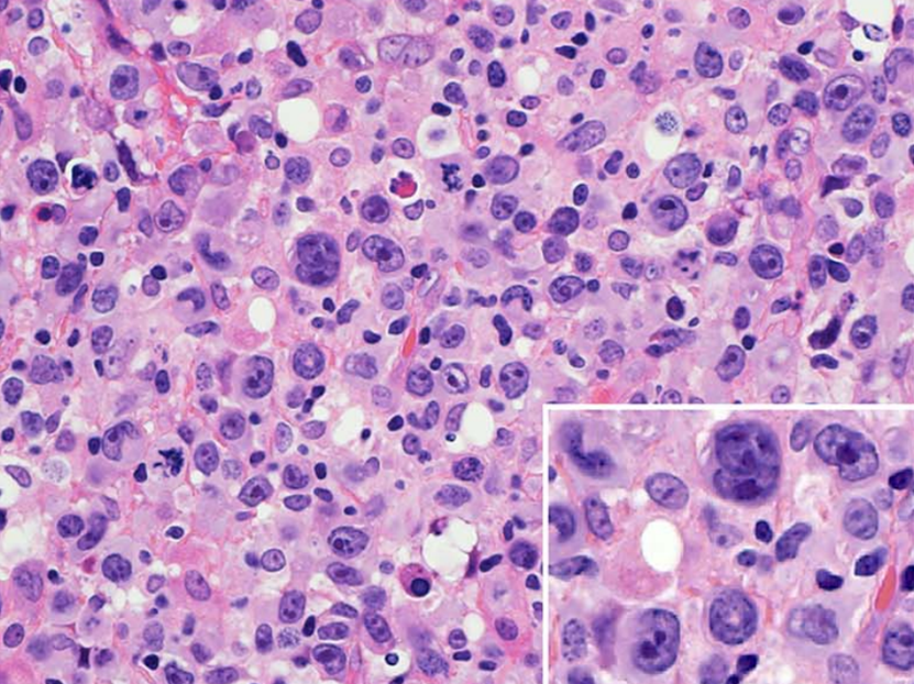 SibaElHussein's tweet image. 🩸Continuing with the theme of ALCL-mimickers, extranodal NK/T-cell with anaplastic morphology is an underrecognized variant that seems to be highly aggressive &amp;amp; potentially misdiagnosed

🩸Below is a photo of a case of extranodal NK/T-cell lymphoma with a striking anaplastic…