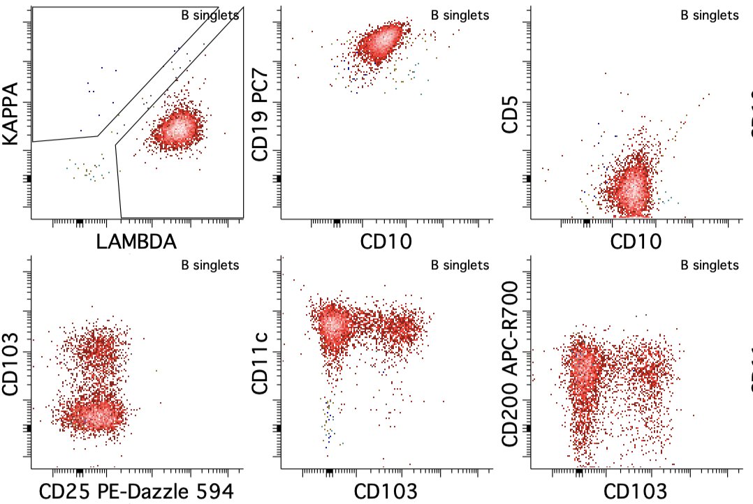 A nice example of splenic B-cell lymphoma/leukemia with prominent nucleoli, aka hairy cell leukemia-variant