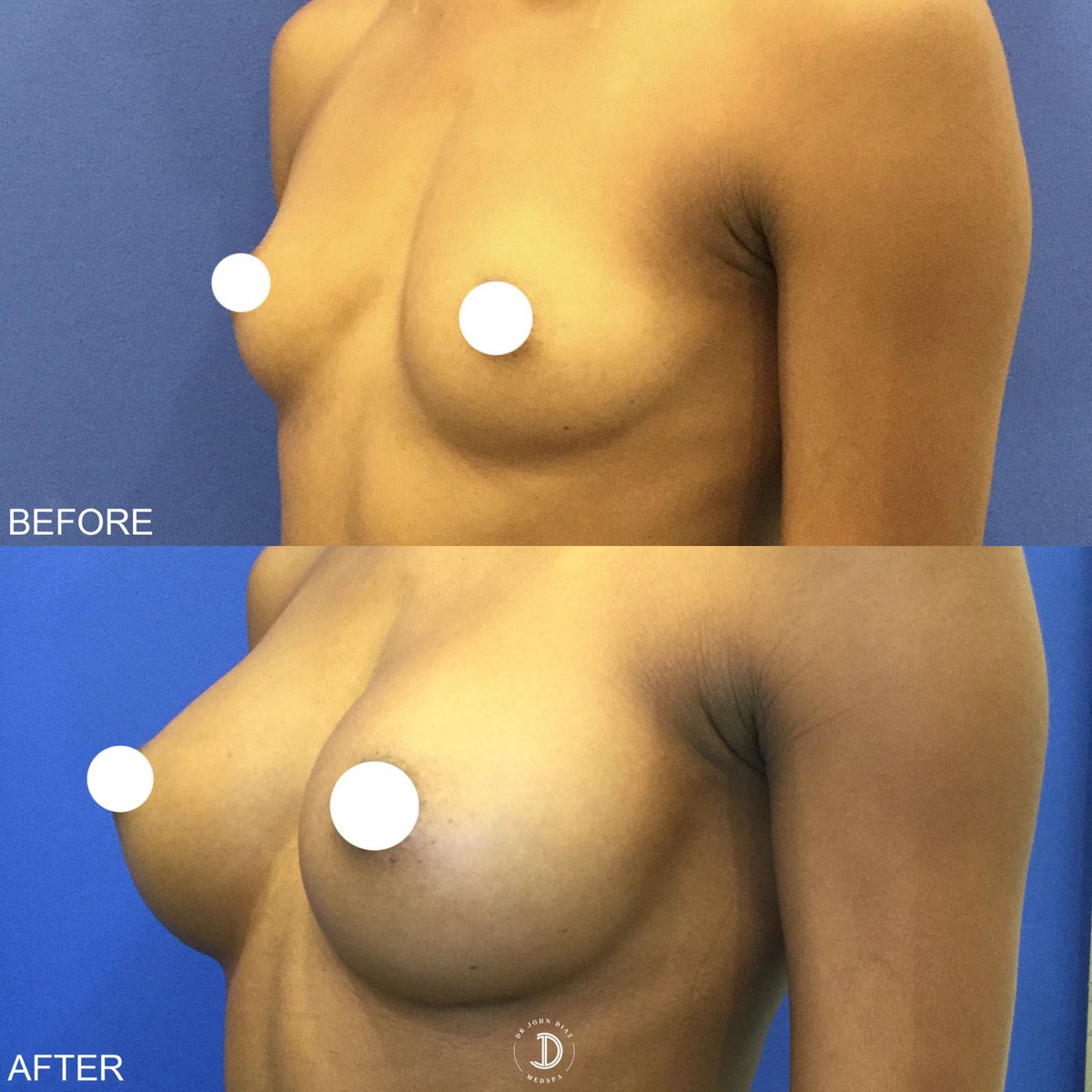 Infinity Breast Augmentation