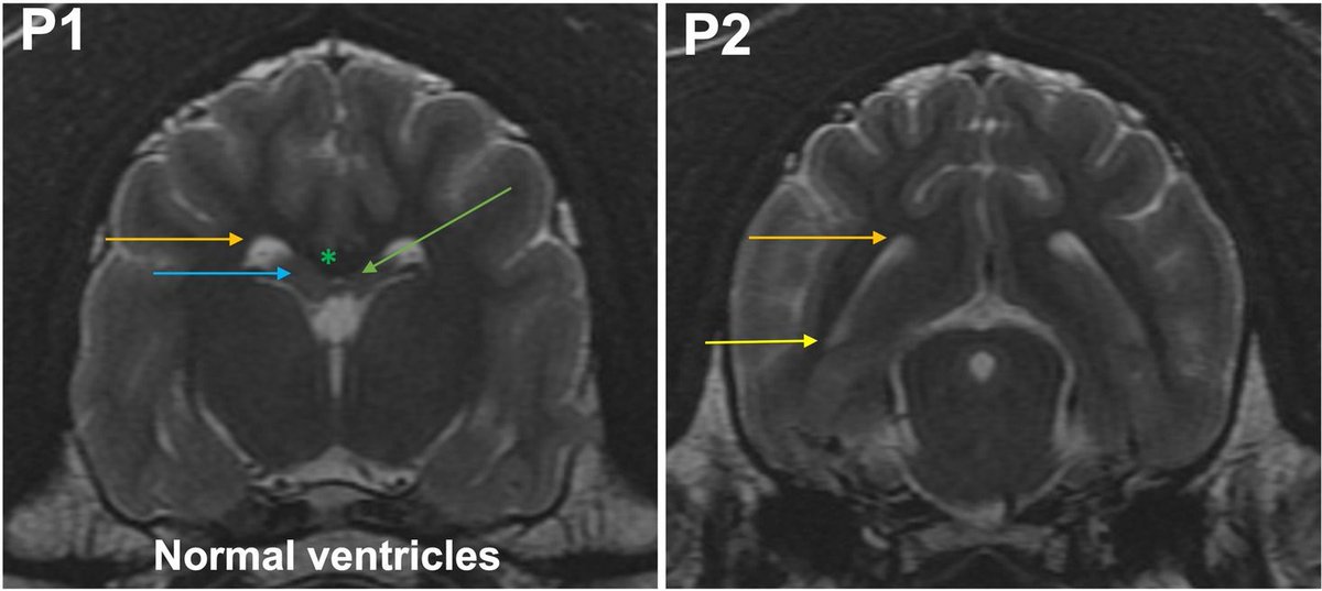 Albinovet's tweet image. reliability and interobserver variability of a grading system of #ventricular distension in dogs. Internal #hydrocephalus is the most common malformation of the central nervous system in dogs.  buff.ly/49ZjZHk