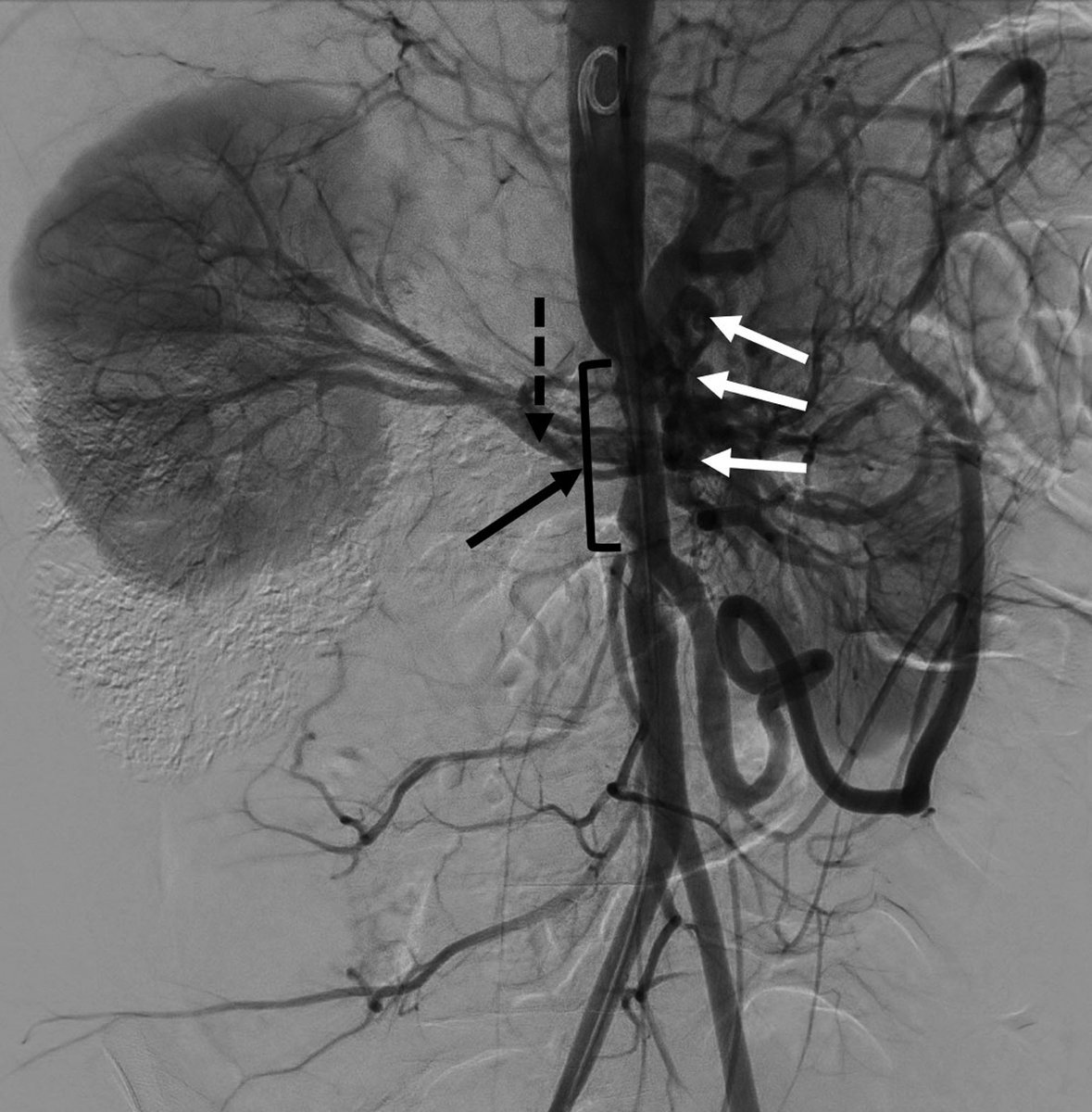 Images in #Anesthesiology - Mid-Aortic Syndrome 📷 ow.ly/nPjH50QeBo3