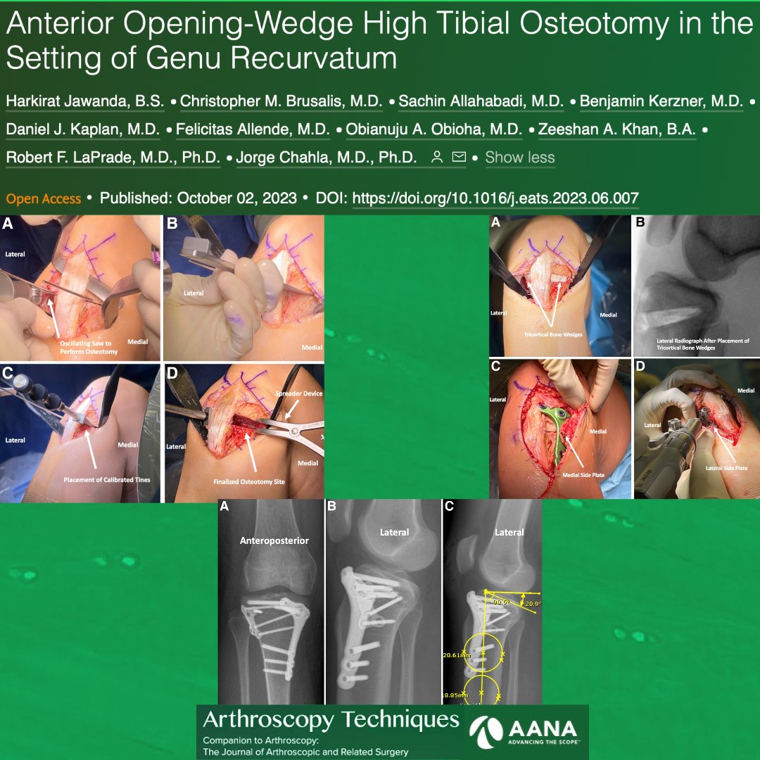 Have a patient with symptomatic genu recurvatum? Check out this technique paper to correct the limb sagittal alignment and provide stability to the knee joint, aiming to improve patient outcomes! ow.ly/O3fF50Q4EK3 #Recurvatum #Knee #Sports @jachahla @MOR_Docs @thekneedoc