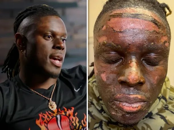 Wild: #Browns TE David Njoku burned 17 percent of his body in the bonfire accident that happened earlier in the season, according to doctors. 

It was described as “probably the most painful burn you can have."

Njoku still managed to play in a football game right after suffering