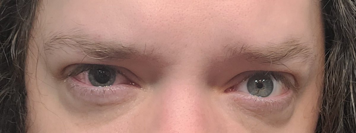 TanukiDanShow's tweet photo. I've noticed since the last eye procedure that my eye is just...  stuck dilated? https://t.co/6pPtcwzImg