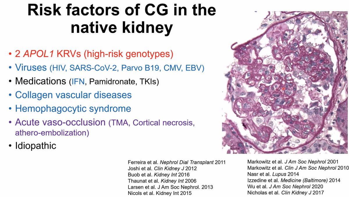 Great lecture from <a href="/IbrahimBatal9/">Ibrahim Batal</a> @MGHKidneys <a href="/mgh_transplant/">Mass General Transplant</a> about collapsing glomerulopathy post-transplantation