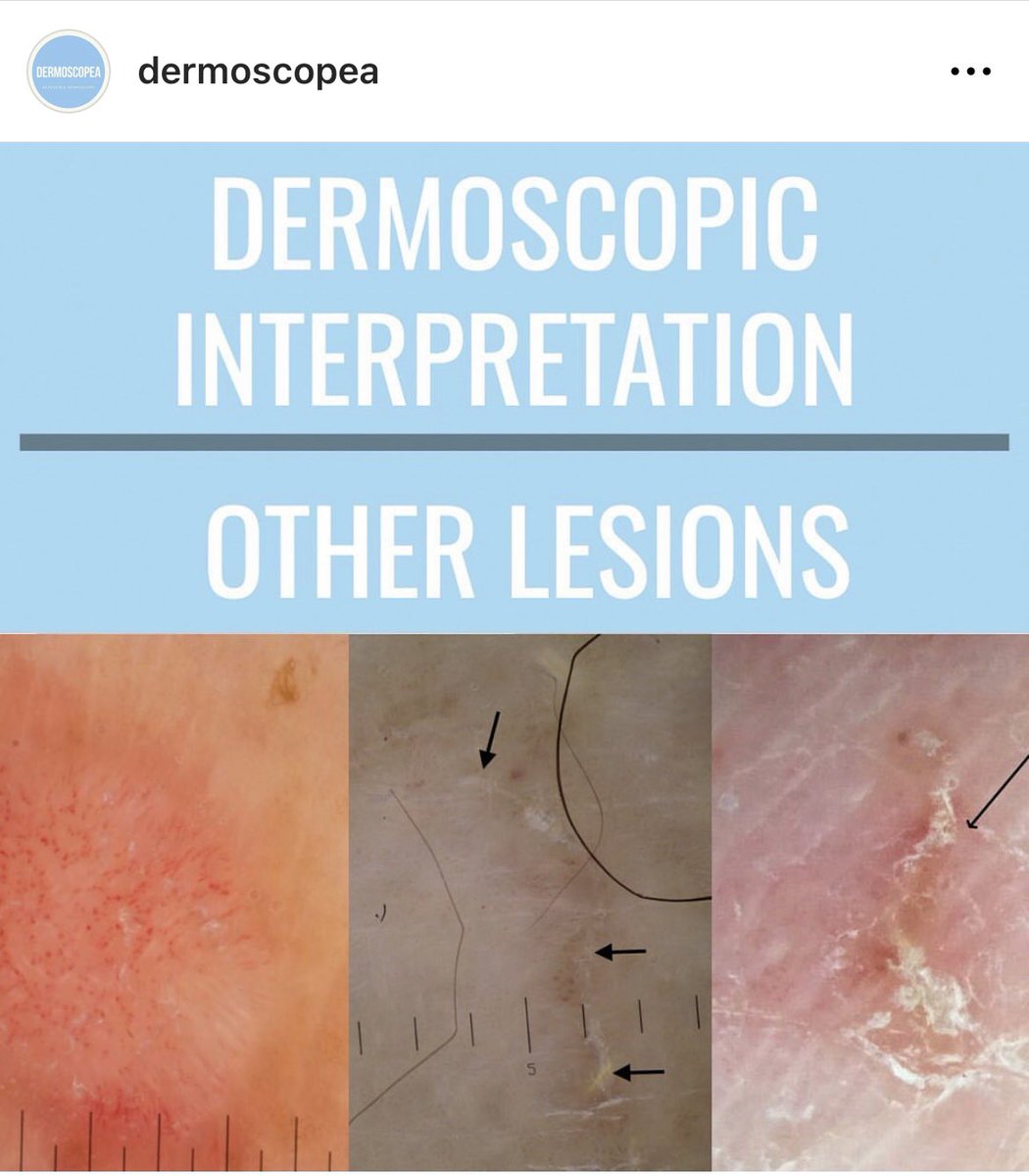 heyitshagz's tweet photo. Beyond grateful to be part of Dermoscopea team!🌟
Glad I had the opportunity to work on the scabies section of the project🩵

https://t.co/BdxUbcdBuW https://t.co/G9NigDtuUz