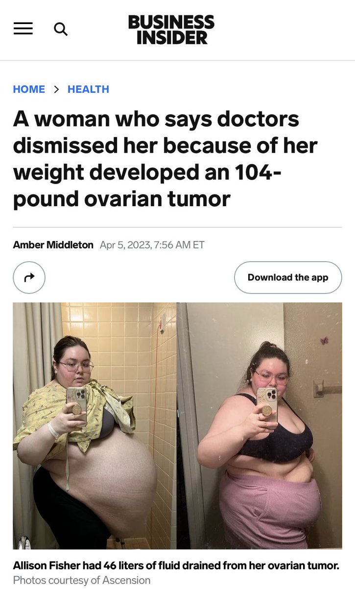 Medical Fatphobia: It is ridiculous to suggest weight loss, given how many doctors missed critical diagnoses by wrongfully assigning symptoms to one’s weight.

This woman was told to lose weight by doctors who missed that she had a 104-pound ovarian tumor since the 5TH GRADE!