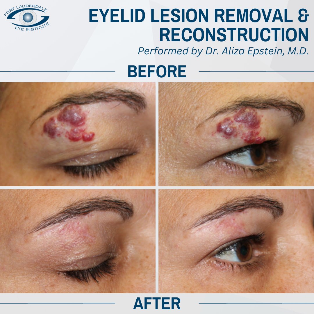 fleieye's tweet photo. Eye Lesion Removal &amp; Reconstruction performed by Aliza Epstein, M.D. of Fort Lauderdale Eye Institute 
Call for a consultation 954-741-5555 

#eyelidsurgery #ophthalmology #southflorida #fortlauderdaleeyeinstitute https://t.co/cKw16l6ZEL