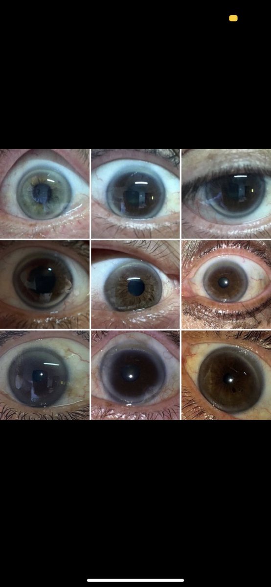 Medicinemia's tweet photo. Corneal Arcus https://t.co/hctijv96fi