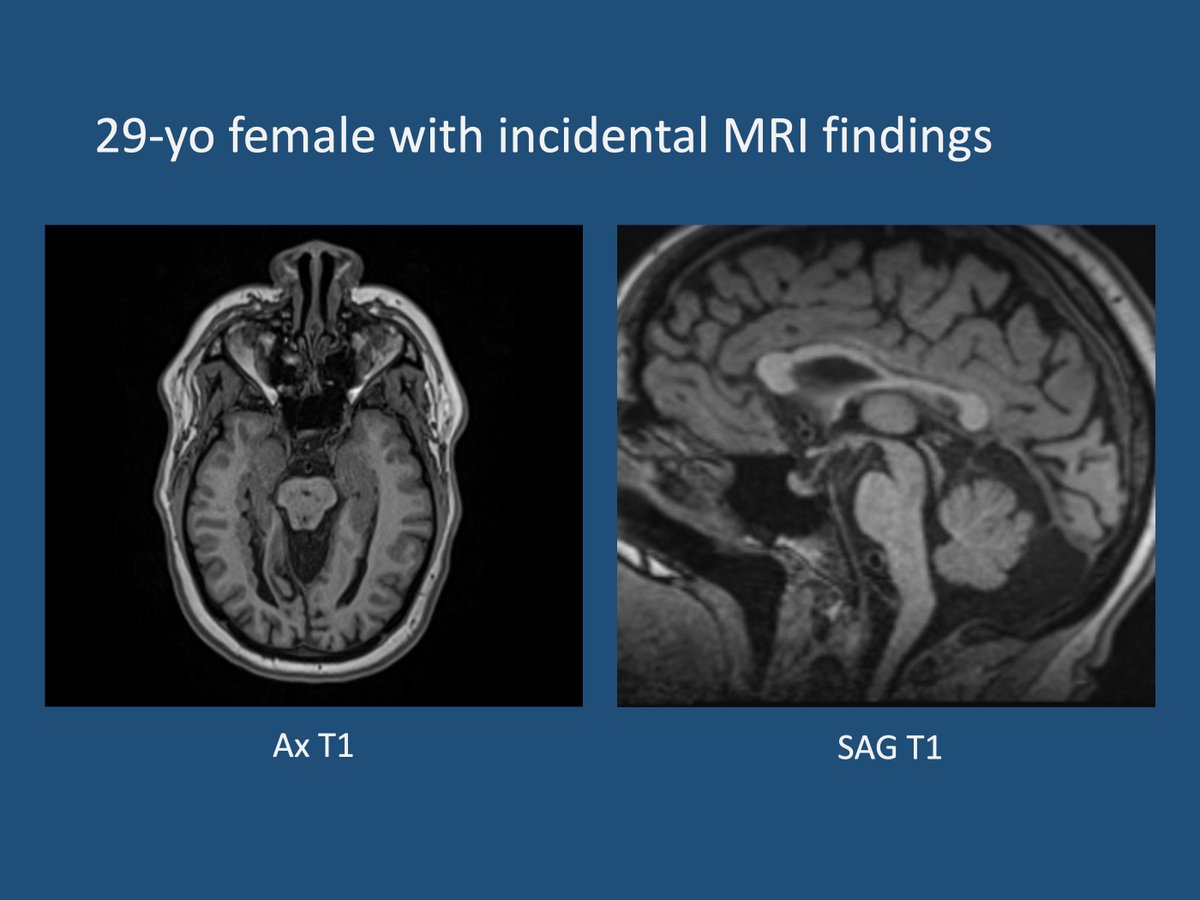 unc_neurorads's tweet image. [UNC Case of Month 202311]
29-yo female with incidental MRI findings after stroke survey. Hx of thoracic aortic aneurysm and scoliosis.

@UNCRadiology @UNCRadRes @The_ASPNR 
#neuroradiology #pediatricneuroradiology #neurology #childneurology #heterotopia #epilepsy