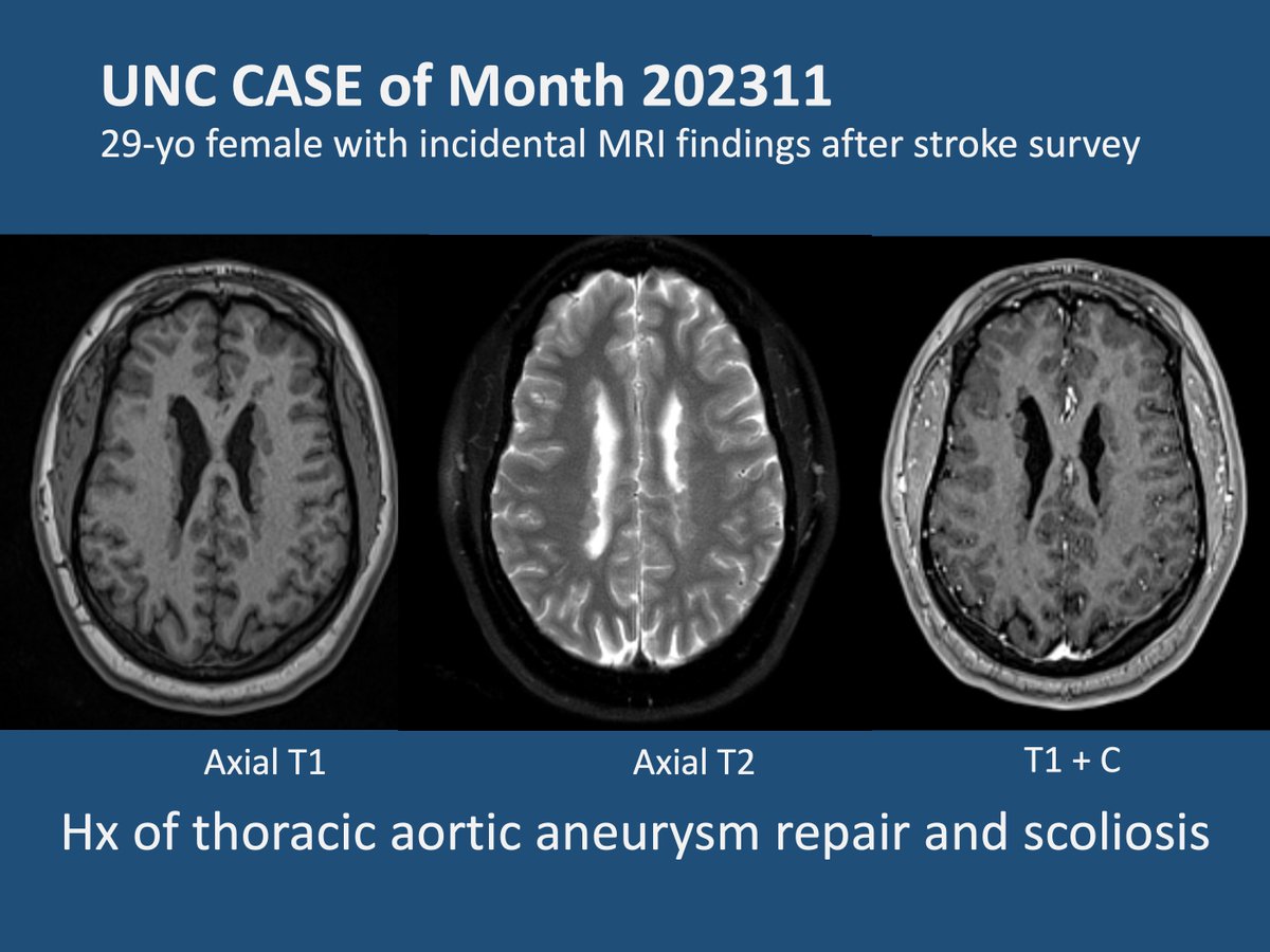 unc_neurorads's tweet image. [UNC Case of Month 202311]
29-yo female with incidental MRI findings after stroke survey. Hx of thoracic aortic aneurysm and scoliosis.

@UNCRadiology @UNCRadRes @The_ASPNR 
#neuroradiology #pediatricneuroradiology #neurology #childneurology #heterotopia #epilepsy