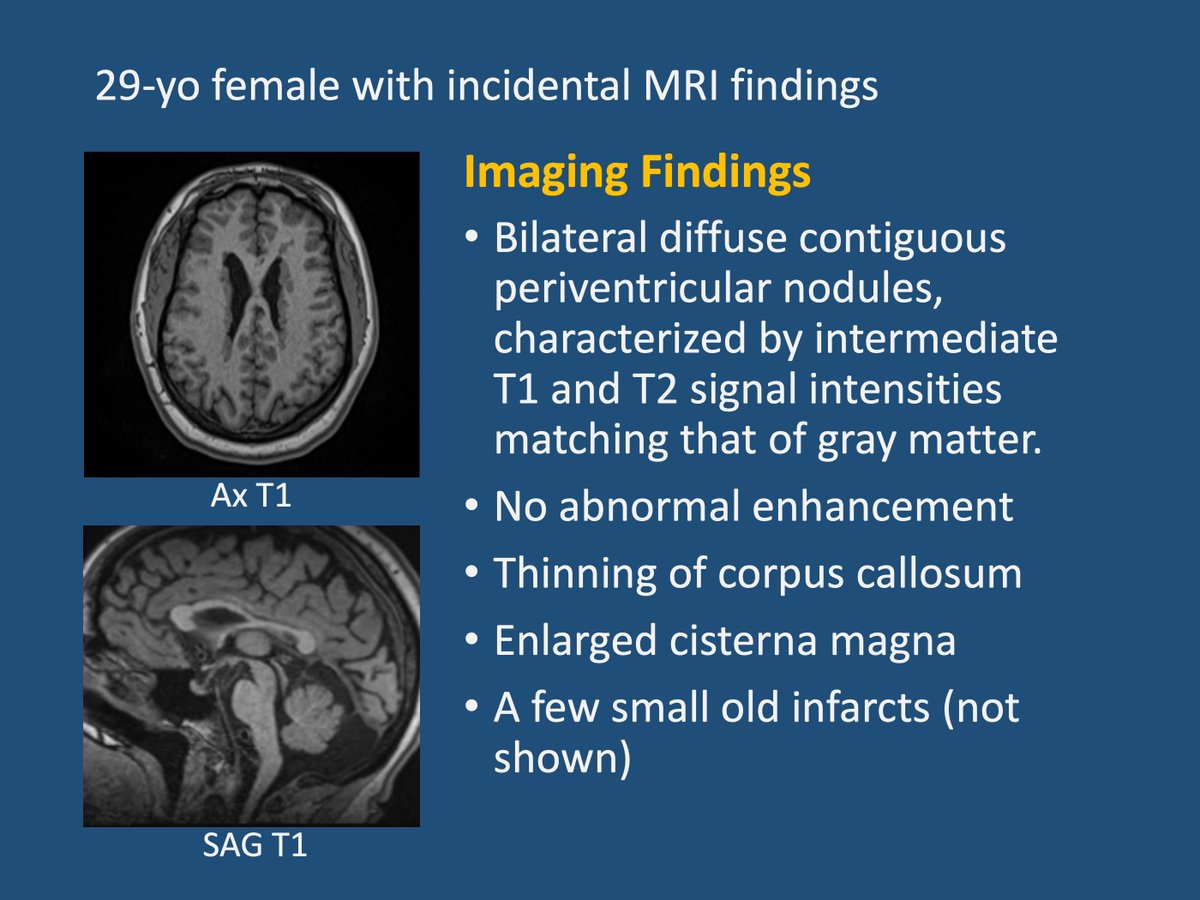 unc_neurorads's tweet image. [UNC Case of Month 202311]
29-yo female with incidental MRI findings after stroke survey. Hx of thoracic aortic aneurysm and scoliosis.

@UNCRadiology @UNCRadRes @The_ASPNR 
#neuroradiology #pediatricneuroradiology #neurology #childneurology #heterotopia #epilepsy
