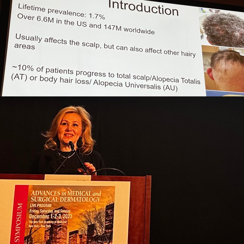 Dr. <a href="/EmmaGuttman/">Emma Guttman-Yassky</a> discussed “Alopecia Areata New Developments”
-The systemic treatment landscape continues to expand. 
-Atopy seems to be a good prognostic factor in AA. 
-Dose &amp; time matter in treatment of AA. 
 #DermWinterSymposium23 #research #innovation #clinicaltrials