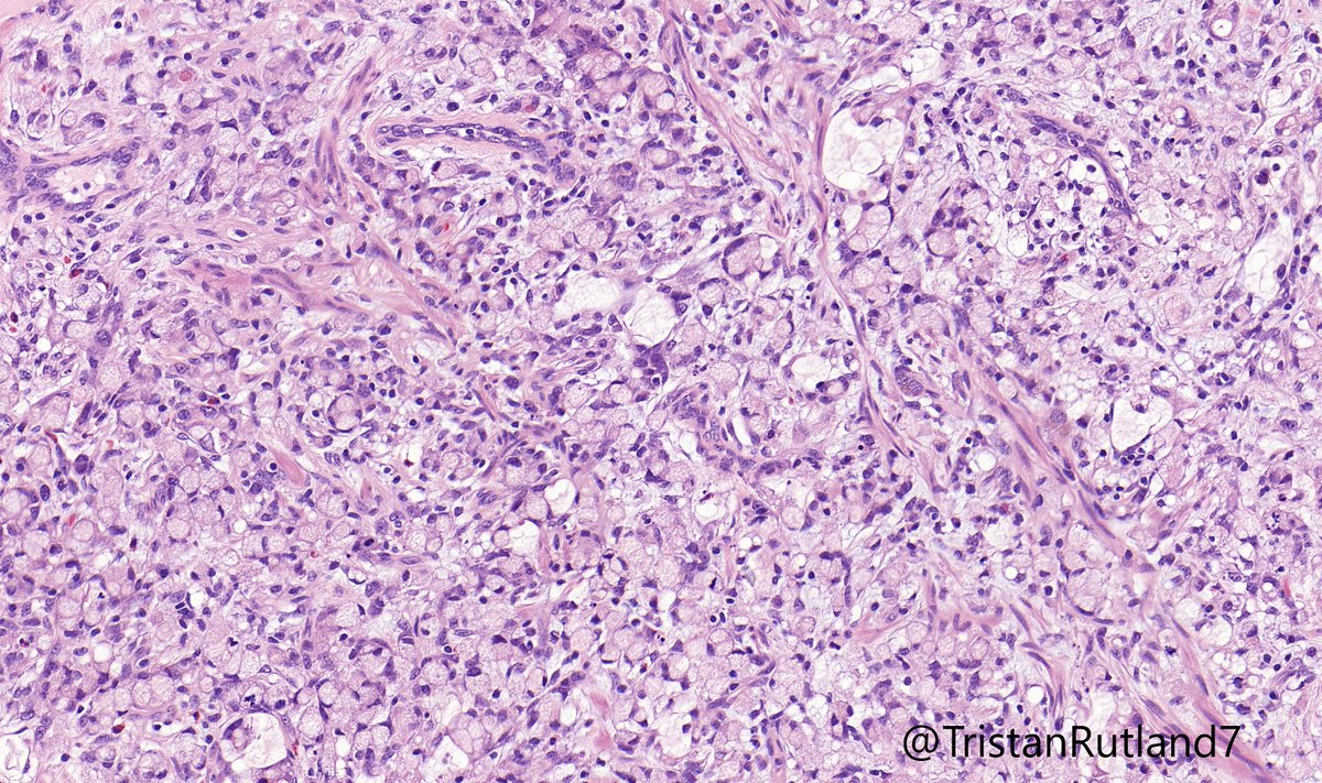 Appendix, female adult

#GIpath #Gynpath #Pulmpath #pathtwitter #Pathresidents