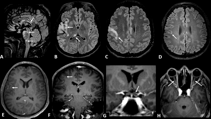 23 year old man with headache, left sided weakness, blurry vision, confusion, and seizure 3 weeks after receiving the Pfizer-BioNTech COVID-19 mRNA vaccine diagnosed with FLAMES (FLAIR-hyperintense lesions in anti-MOG-associated encephalitis with seizure) thieme-connect.de/products/ejour…