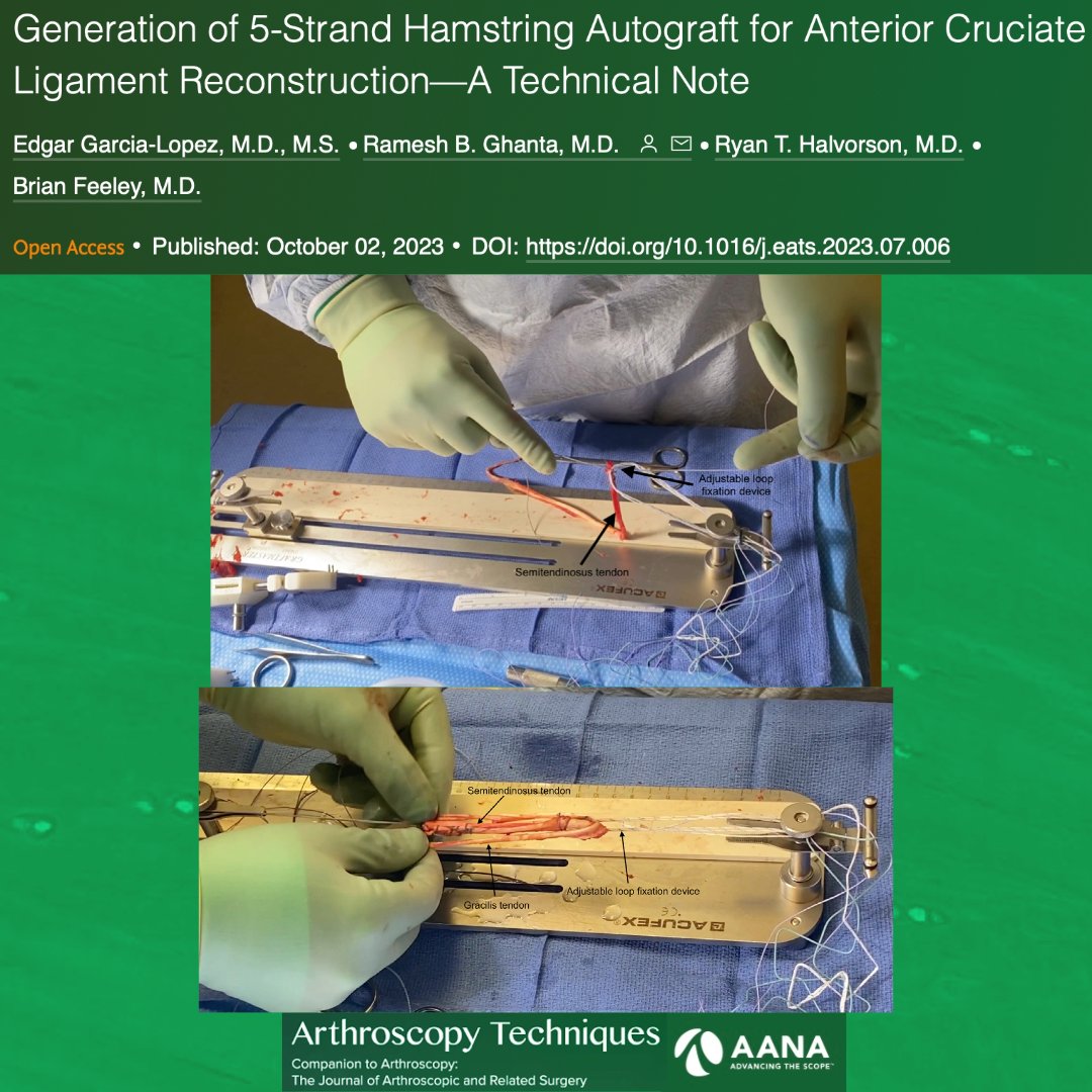 Check out this technique paper to maximize graft diameter for ACL reconstruction, especially in patient populations with undersized hamstring tendons at baseline. ow.ly/kV8650Q4F2T #ACLR #ACL #Hamstring @drbrianfeeley @ucsforthosurg @RyanHalvorson80 @RameshBGhanta