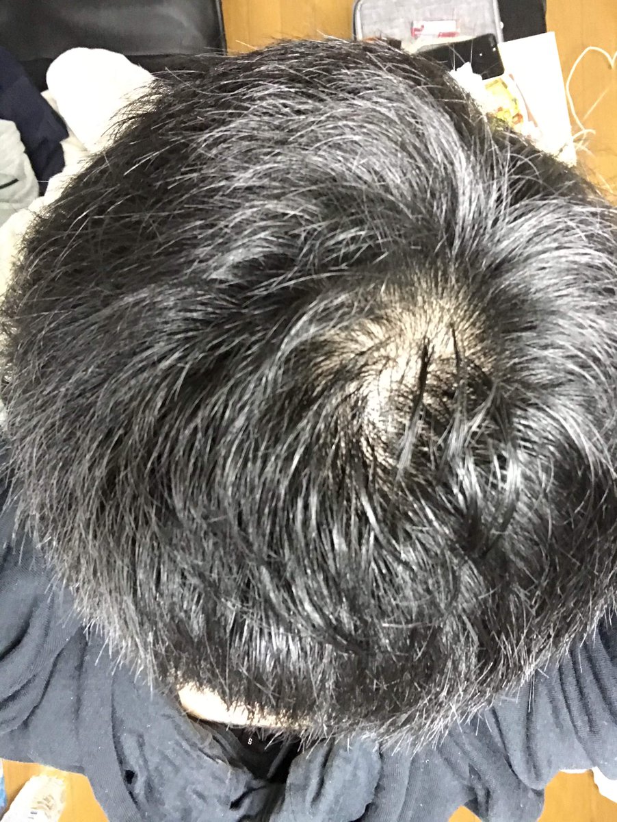 bibiriaga's tweet photo. 同じ日に撮った写真だけど、光の度合いによってだいぶ見え方が違う。
自分で撮影すると意外と客観的に変化を見るのって難しい。
光の当たり方によって思ったより薄毛に見えることもあれば逆もある。
誰かに撮ってもらうのが一番だけど、それはそれでハードルが高い。 https://t.co/6tB0lMJgFE