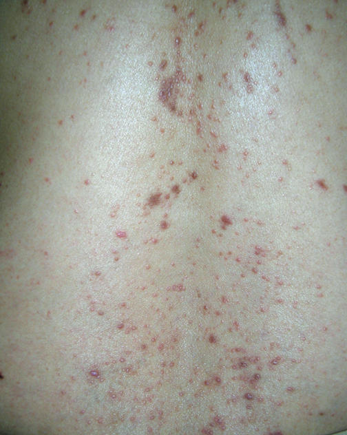 What is the diagnosis ? Six Ps (planar, purple, polygonal, pruritic ...