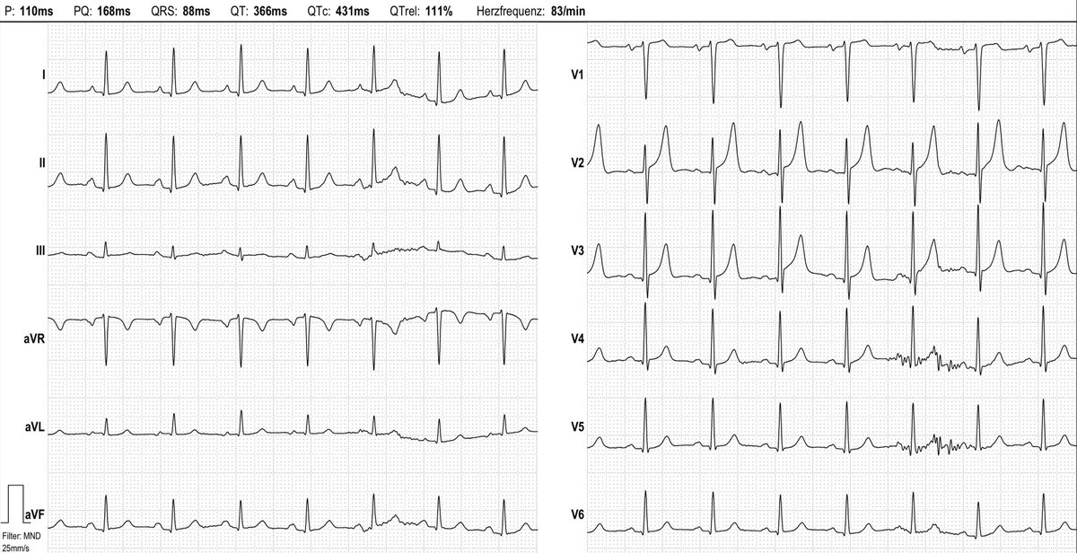 ecgandrhythmRoe's tweet photo. 73 yo male, no chest pain, K+ normal; what do you think? https://t.co/MNtpVRvLya