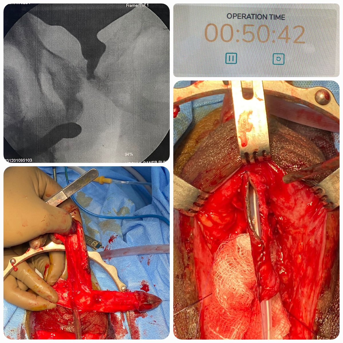 Week of complex cases in #Urokul. 3 cases of #bulbarnecrosis. Required pedicle preputial flap. Operation time: 50 minutes (all cases with inferior pubectomy) by @drjoshi_pankaj