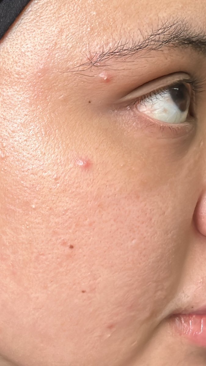 ketengahketepi's tweet photo. Korang pakai berapa layer skincare or buat la treatment mahal macam mana pun. 😊🤲🏻your skin tetap akan jadi 2 minggu flawless, 2 minggu lagi keluar jerawat sebab period

ni kulit i time nak period. https://t.co/tgfKEgT6Yv