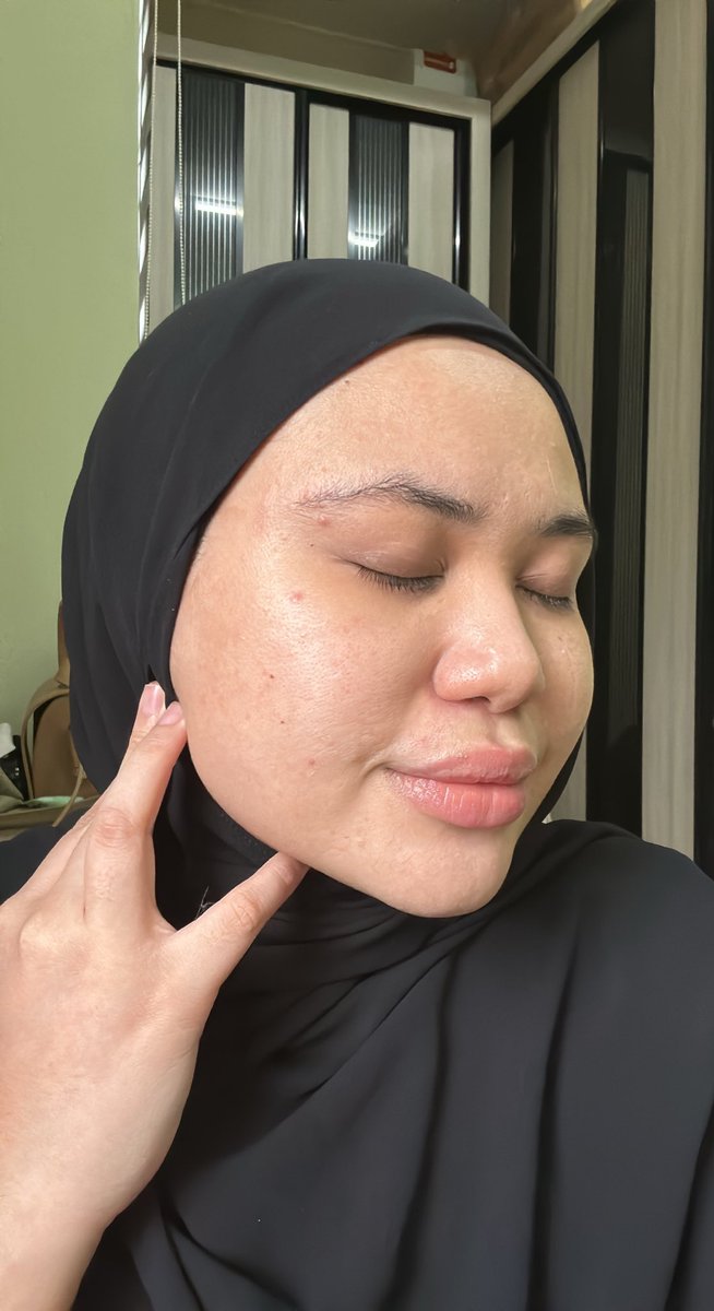 ketengahketepi's tweet photo. and this is my skin after i treat with 16PERCENT skincare selama 1 minggu lebih. jerawat dh kecut 

kalau i biar je tak pakai apa apa, confirm dia takkan hilang. Jerawat tu akan stay and bertambah la jawabnya sampai next period.

ITS GETTING BETTER KAN? https://t.co/HisWi1GUAn