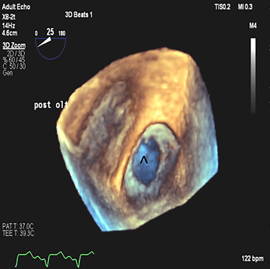Archer Martin (@archerkmartin) on Twitter photo 3D TEE is an important tool for the full evaluation of pulmonary vascular anastomoses in 🫁 transplantation - in <a href="/MayoClinic/">Mayo Clinic</a> Proceedings this month
<a href="/avfDO/">Ashley Virginia Fritz D.O.</a> <a href="/AG_EM33/">Alin Gragossian, DO, MPH</a> <a href="/KalagaraHari/">🩺 Hari (హరి 🇮🇳) Kalagara</a> <a href="/MayoAnesthesia/">Mayo Clinic Department of Anesthesiology</a> <a href="/mayojaxanes/">MCF Anesthesiology Residency</a> <a href="/MayoAnesRes/">MayoAnesthesiaResMN</a> <a href="/ProfAnnaReed/">Nonni 💙</a> <a href="/DocCalabrese/">Daniel Calabrese</a>
mayoclinicproceedings.org/article/S0025-… 3D TEE is an important tool for the full evaluation of pulmonary vascular anastomoses in 🫁 transplantation - in <a href="/MayoClinic/">Mayo Clinic</a> Proceedings this month
<a href="/avfDO/">Ashley Virginia Fritz D.O.</a> <a href="/AG_EM33/">Alin Gragossian, DO, MPH</a> <a href="/KalagaraHari/">🩺 Hari (హరి 🇮🇳) Kalagara</a> <a href="/MayoAnesthesia/">Mayo Clinic Department of Anesthesiology</a> <a href="/mayojaxanes/">MCF Anesthesiology Residency</a> <a href="/MayoAnesRes/">MayoAnesthesiaResMN</a> <a href="/ProfAnnaReed/">Nonni 💙</a> <a href="/DocCalabrese/">Daniel Calabrese</a>
mayoclinicproceedings.org/article/S0025-…
