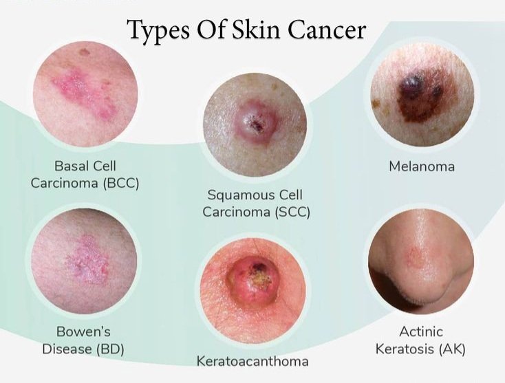 #skincancerawareness #skincancer #skincancerprevention #skincancerscreening #skincanceractionweek #SkinCancerTreatment homeodriqbal.pk