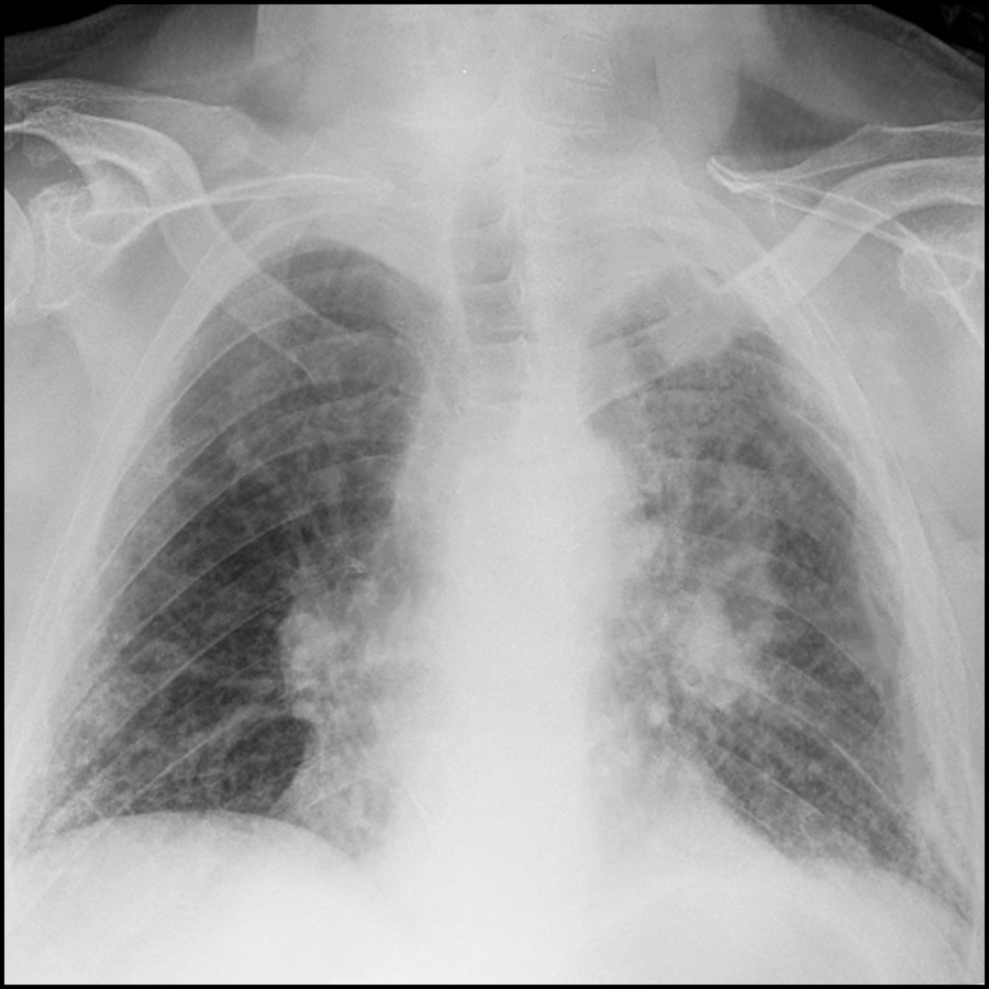 A proposed global definition of #ARDS adopts new evidence and practice to expand the diagnostic criteria for ARDS and improve the generalizability for resource-limited settings. Read the December 2023 Science, Medicine, and the Anesthesiologist: ow.ly/X0MK50QeBuj