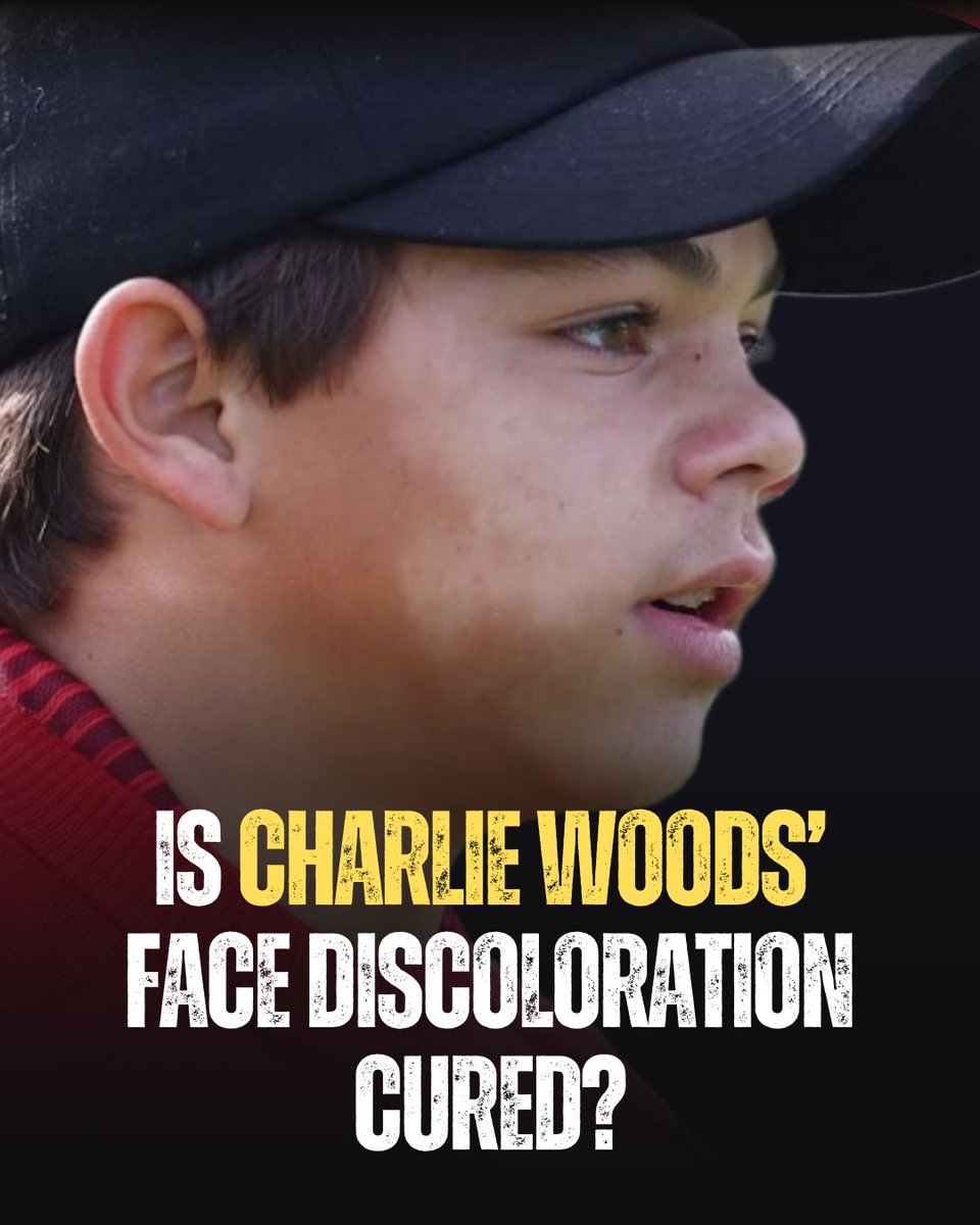 ClubGolfUpdates's tweet photo. Is Jr. Woods facing a skin condition?

#golf #tigerwoods #charliewoods https://t.co/QajCuJDA8l