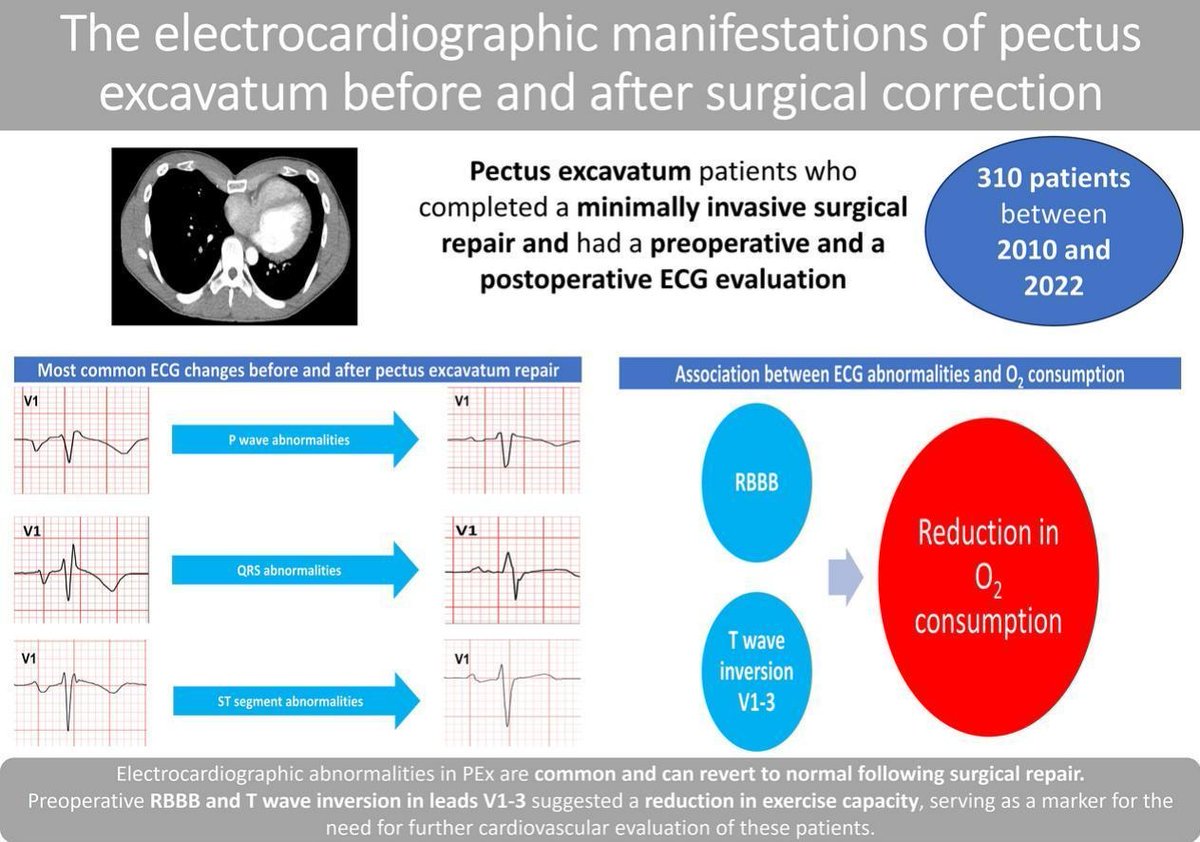 The electrocardiographic manifestations of pectus excavatum before and after surgical correction #NewOnline #JECG doi.org/10.1016/j.jele…