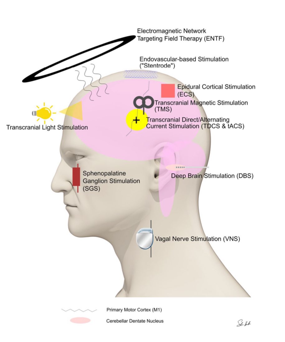 A depiction of direct current stimulation for treatment of a