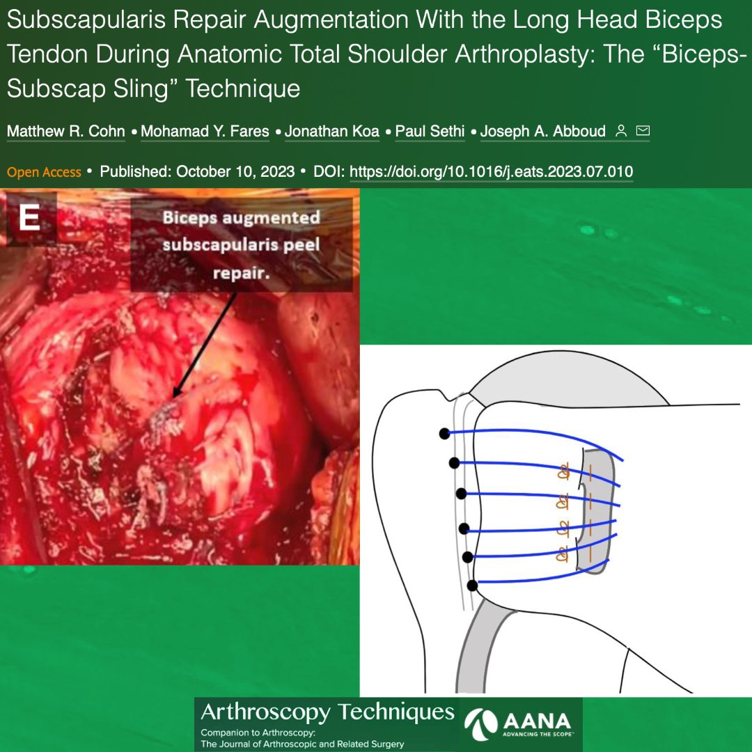 This technique, termed the “Biceps-Subscap Sling” technique, provides additional structural integrity to subscapularis repair and is a cost-effective, biologically active option. ow.ly/M68050Q4PiI #Biceps #Subscapularis #Sports #Shoulder @PaulSethiMD