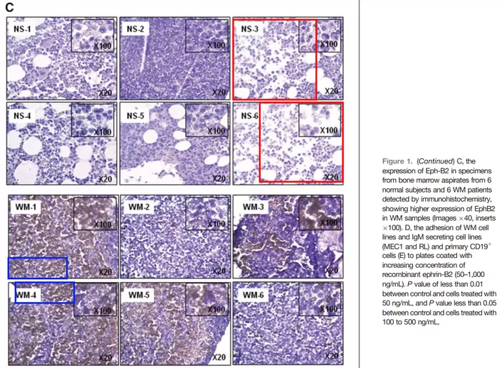 addictedtoigno1's tweet photo. Scientists from Harvard gain ethical approval to aspirate bone marrow from healthy volunteers and cancer patients, then mix up the images during publication. Surely this is an enormous ethical transgression. I would be furious if I volunteered! https://t.co/ViV8K5PUQh