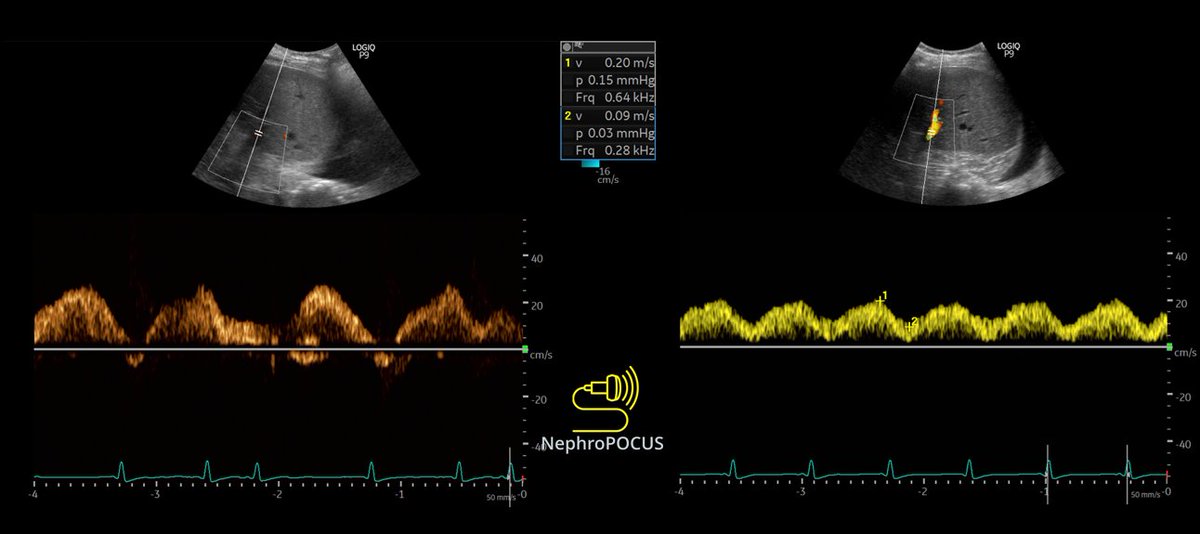 NephroP's tweet photo. Weekend #VExUS ology questions for experts @khaycock2 @MDBeni @WBeaubien 
1. Why is the S-D relationship preserved despite TR and pulmonary hypertension? (IVC plethoric). Noted prominent A-wave (⬆️RVEDP) but still seems inconsistent with RAP and portal waveform.
2. What's the likely reason for variation in PV pulsatility fraction? (yellow trace is obtained in breath hold). Analogue of Carvallo’s sign?