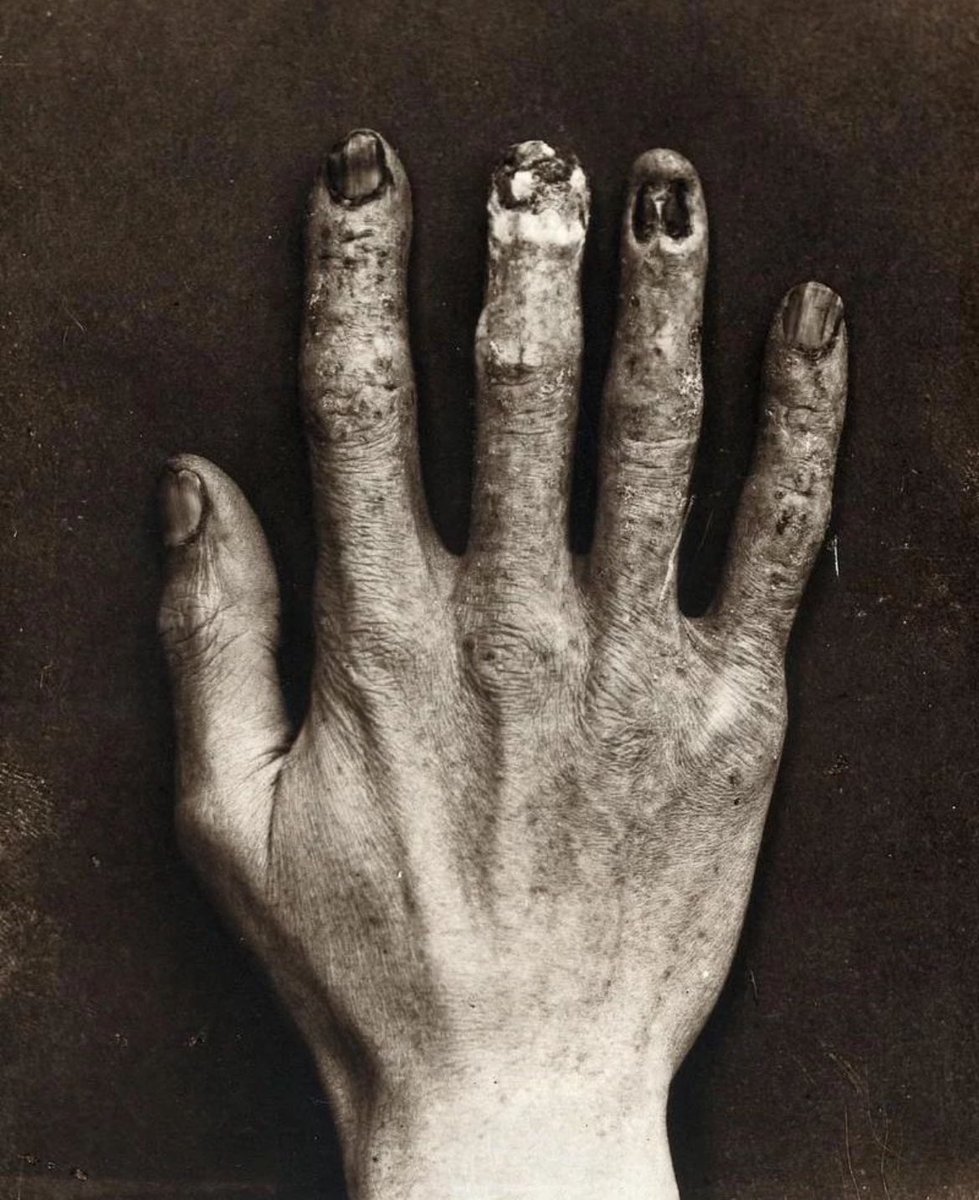 Hand belonging to an X-ray technician at the Royal London Hospital, which shows the damage from radiation exposure, 1900. Every morning, they would calibrate the machines by taking an X-ray of their hands. So you might be wondering, why not just use something else to test the