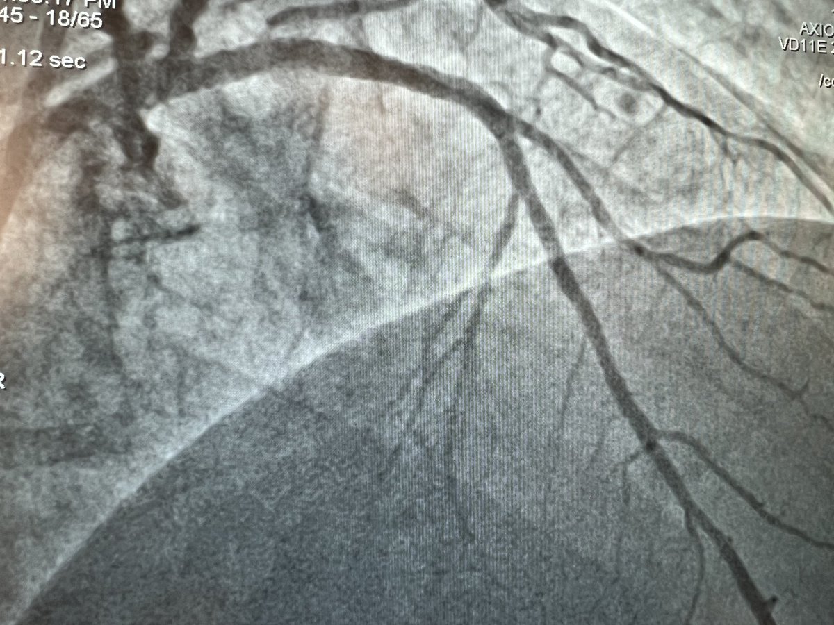 Vladimir Dzavik (@dzavik_vlad) on Twitter photo A privilege to perform the last case of CBS 2023 in Nanjing with Dr. Chen Liang and the expert Nanjing 1st team with <a href="/NielsRHolm/">Niels R. Holm</a> providing expert OCT interpretation. Multiple bifurcation lesions including a LM treated with modified DK crush. <a href="/shaoliang_chen/">Shaoliang Chen</a> A privilege to perform the last case of CBS 2023 in Nanjing with Dr. Chen Liang and the expert Nanjing 1st team with <a href="/NielsRHolm/">Niels R. Holm</a> providing expert OCT interpretation. Multiple bifurcation lesions including a LM treated with modified DK crush. <a href="/shaoliang_chen/">Shaoliang Chen</a>